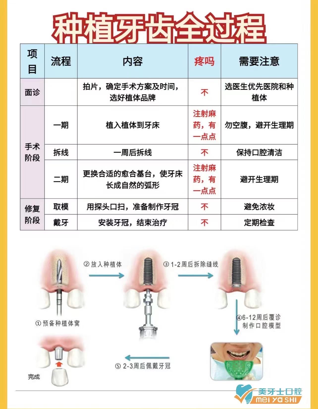 种牙疼吗需要多长时间图片