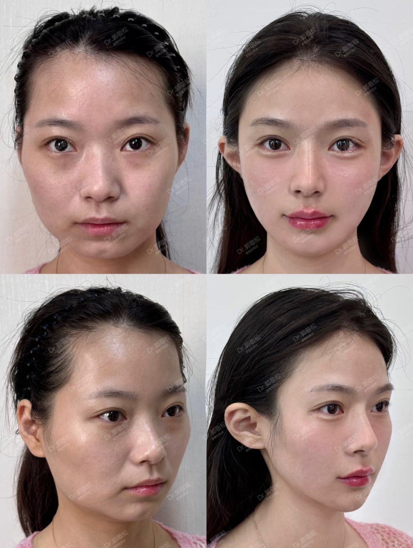 出美女❗❗\\n\\n严重的问题在于下巴平且软组织堆积在下颌两侧