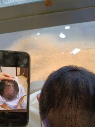 -碧莲盛·不剃发植发