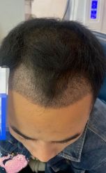 -大麦微针植发丨全国连锁