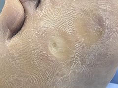 -Andrew指甲专科灰指甲·甲沟炎矫正·3D步态矫形鞋垫定制(浦三路店)