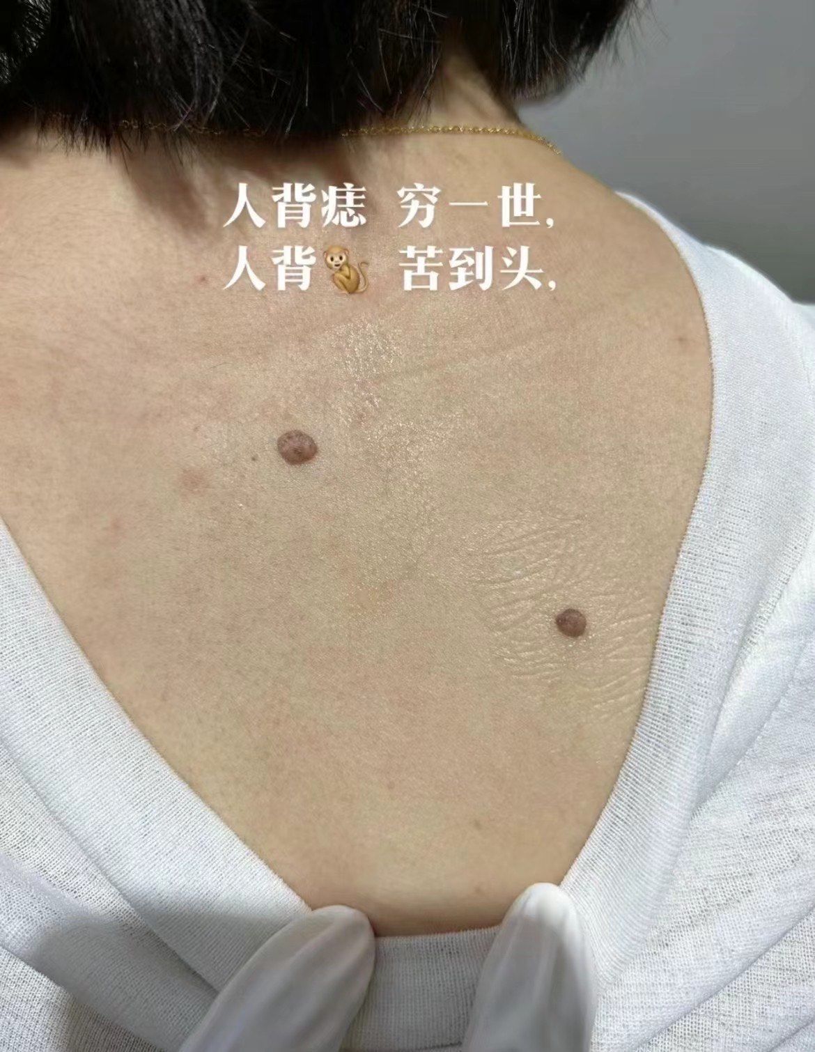 人背痣穷一世 人背🐒苦到头