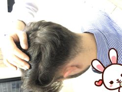 点击看大图 -大麦微针植发丨全国连锁