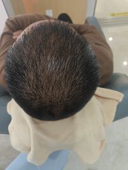 -大麦微针植发丨全国连锁