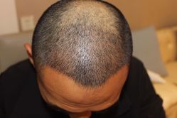 -大麦微针植发全国连锁