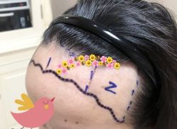 -大麦微针植发全国连锁