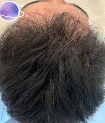 -大麦微针植发丨全国连锁