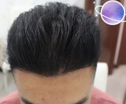 -大麦微针植发丨全国连锁