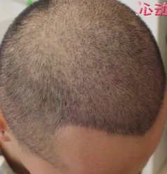 -大麦微针植发丨全国连锁