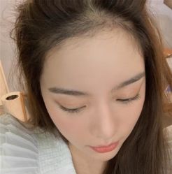 -碧莲盛·不剃发植发