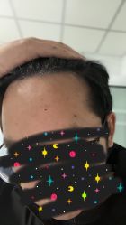 -大麦微针植发丨全国连锁