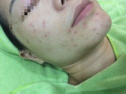 -苗医生草本科技祛痘