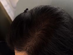 -碧莲盛·不剃发植发