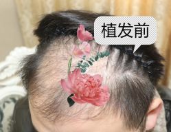 -大麦微针植发全国连锁