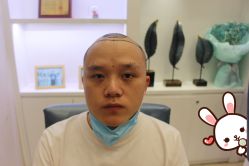 -大麦微针植发丨全国连锁