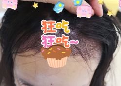 -大麦微针植发全国连锁