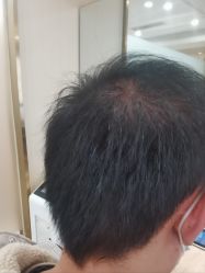 -碧莲盛·不剃发植发