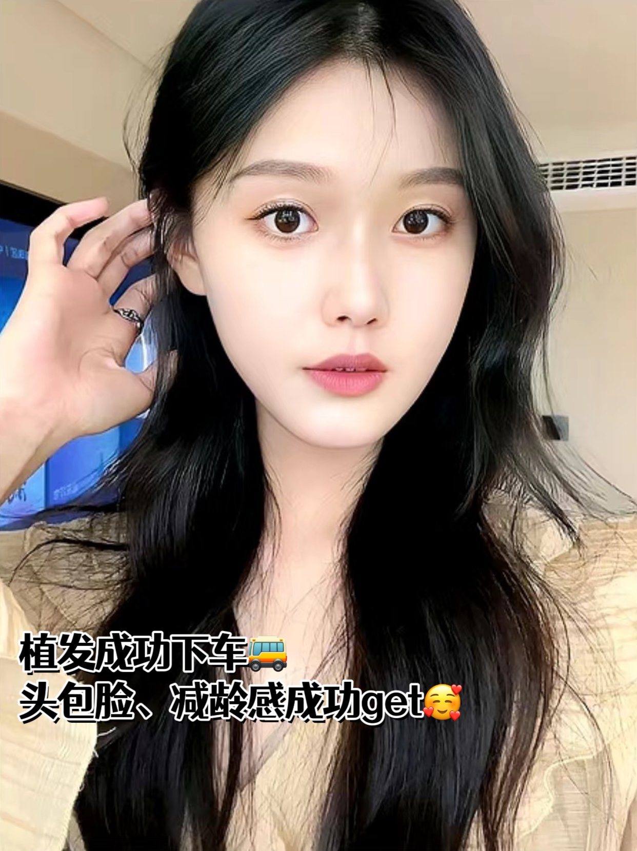 植发参照(植发实际效果)