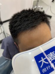 点击看大图 体验后-大麦微针植发全国连锁