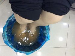 -德哥灰指甲脚气甲沟炎跖疣护理