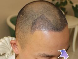 -大麦微针植发丨全国连锁