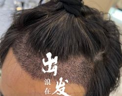 -大麦微针植发全国连锁