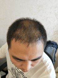 点击看大图 -大麦微针植发丨全国连锁