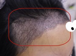 -大麦微针植发全国连锁