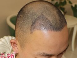 -大麦微针植发丨全国连锁