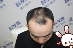 -大麦微针植发丨全国连锁