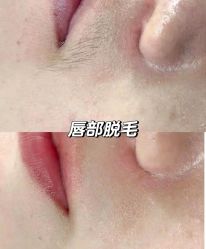 -薇兰专业脱毛连锁机构