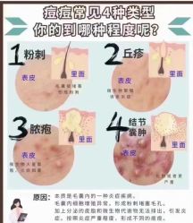 -瑶芳清颜草本祛痘
