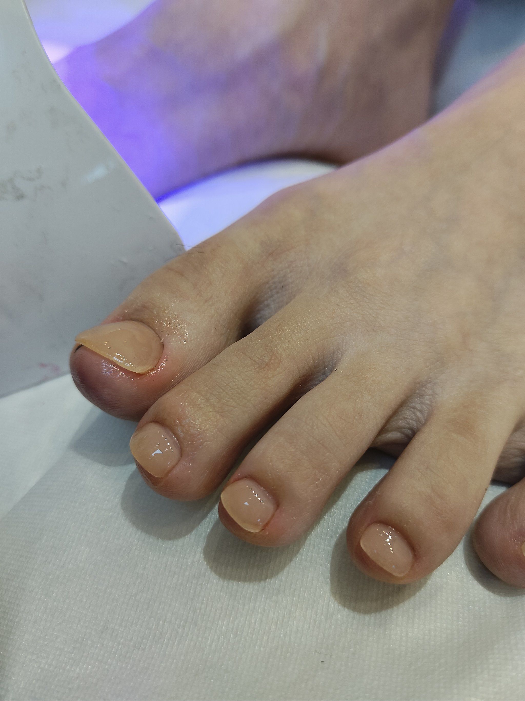 上海水晶矫正大脚趾#上海水晶矫正歪斜甲小翘甲#上海水晶矫正大拇哥