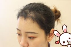 -大麦微针植发丨全国连锁