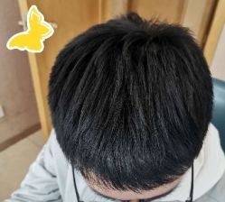 -大麦微针植发丨全国连锁