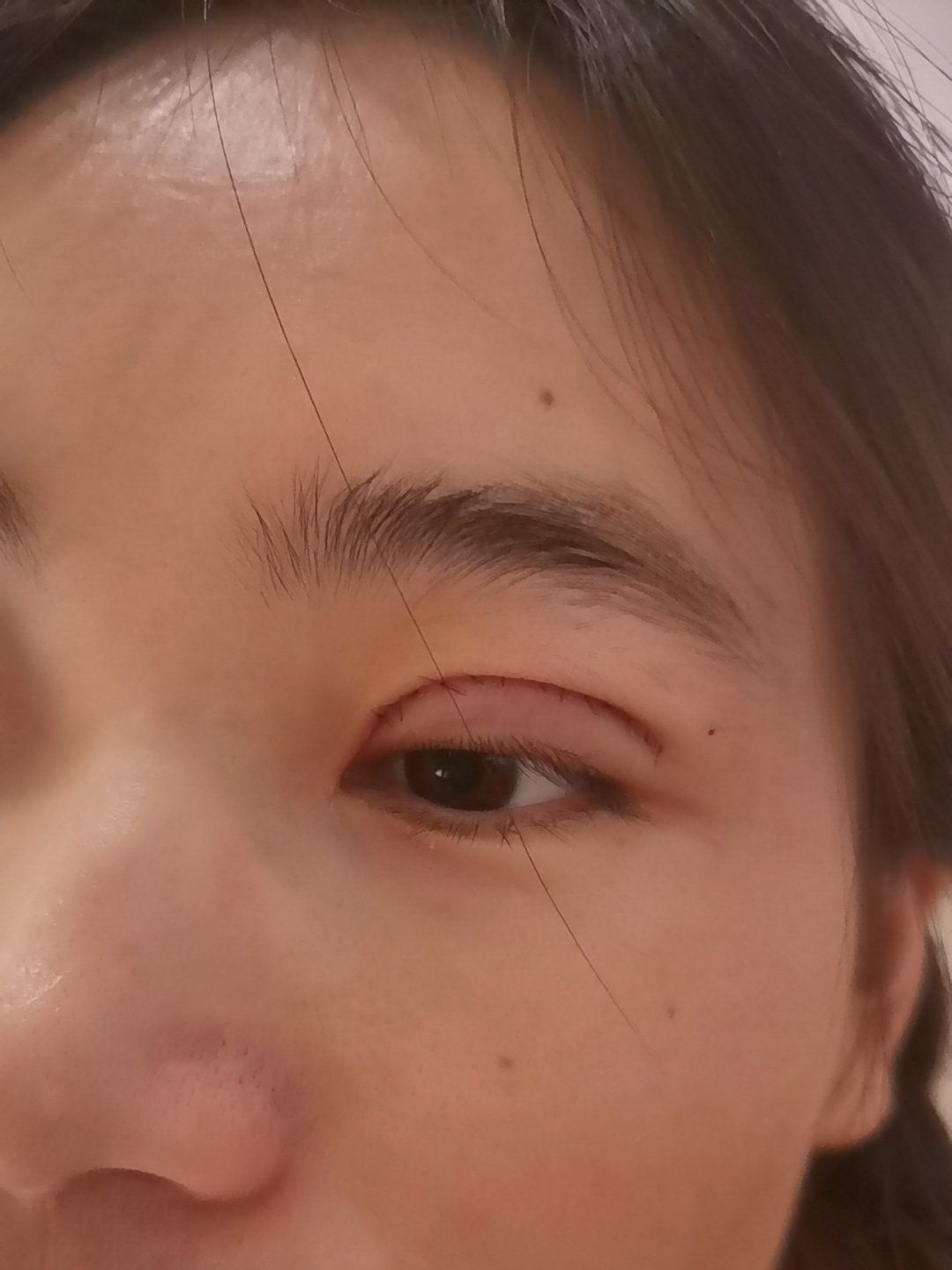 割双眼皮前后对比