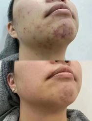 -瑶芳清颜草本祛痘