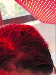 -碧莲盛·不剃发植发