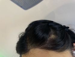 -碧莲盛·不剃发植发