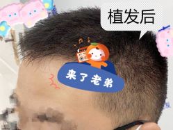 -大麦微针植发全国连锁