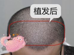 -大麦微针植发全国连锁