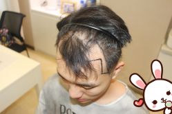 点击看大图 -大麦微针植发丨全国连锁