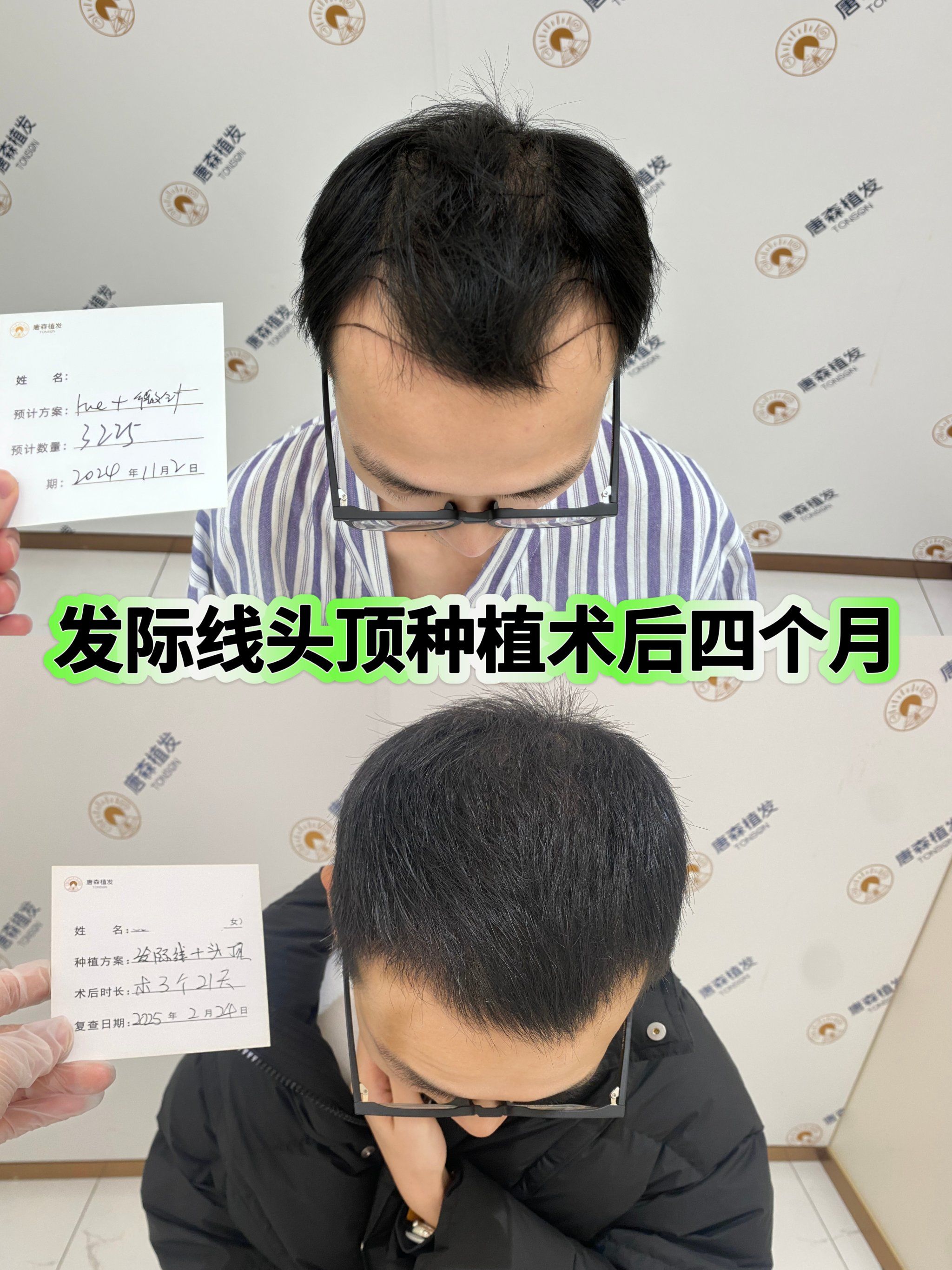 植发四个月,我终于和大光明说拜拜啦!