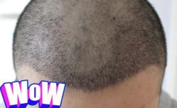 -大麦微针植发丨全国连锁