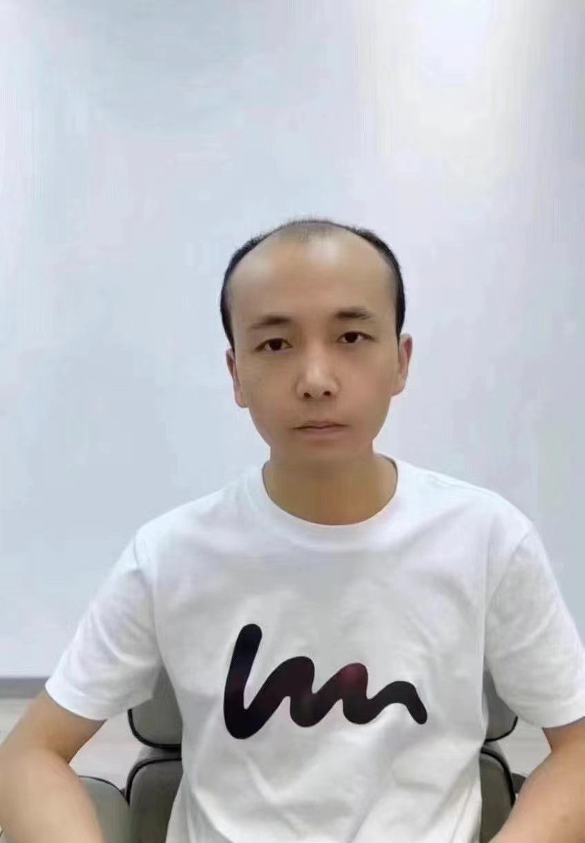 男士头发稀少秃顶适合什么发型?