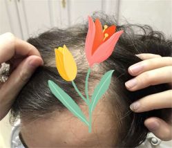 点击看大图 -大麦微针植发全国连锁