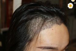 -大麦微针植发丨全国连锁