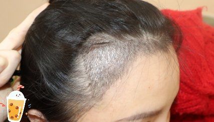 -大麦微针植发丨全国连锁