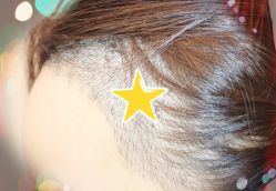 -大麦微针植发全国连锁