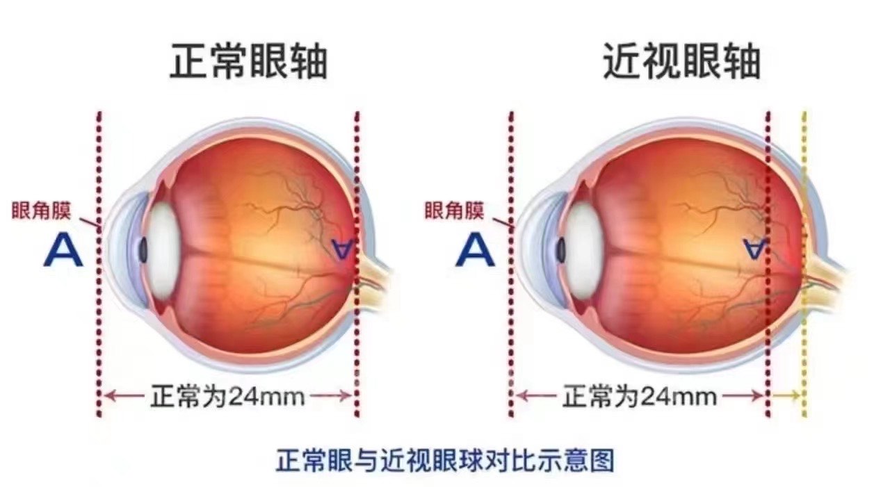 近视眼与正常眼图片